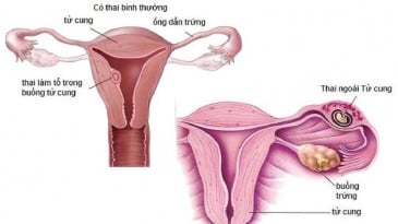 Viêm ống dẫn trứng nguy cơ gây vô sinh ở nữ giới
