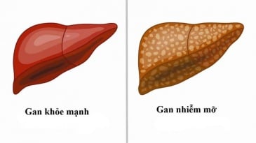 Nguyên nhân gây bệnh gan nhiễm mỡ không do rượu