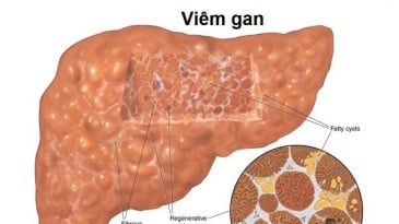 Gan nhiễm mỡ có mấy cấp độ? Có trị được không?