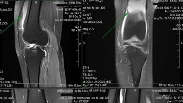 Quy trình chụp cộng hưởng từ khớp không tiêm thuốc đối quang từ