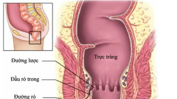 Quy trình chụp cộng hưởng từ lỗ rò vùng hậu môn trực tràng