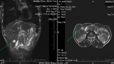 Quy trình chụp cộng hưởng từ ổ bụng không tiêm thuốc đối quang từ