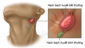 Quy trình chụp cộng hưởng từ bạch mạch có tiêm thuốc đối quang từ đặc hiệu