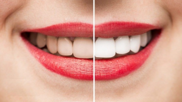 Nguyên nhân gây xỉn màu răng, Các phương pháp tẩy trắng răng và những lưu ý