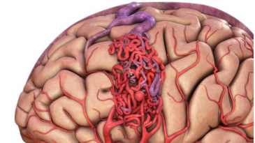 Lưu ý khi chụp cộng hưởng từ (MRI) não và tủy sống