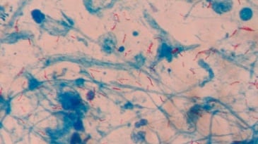 Tìm hiểu Vi khuẩn gây bệnh lao Mycobacterium tuberculosis trên người