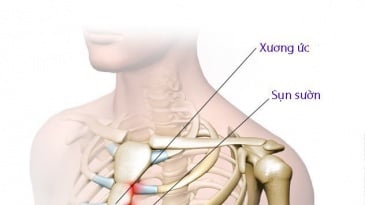 Chụp x quang xương khớp ức đòn là gì? Chuẩn bị, Quy trình chụp và Đánh giá kết quả