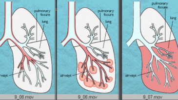 Bệnh phổi kẽ là gì? triệu chứng, các loại bệnh, phương pháp điều trị, phòng ngừa