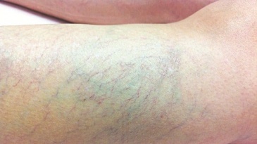 Một số chú ý về bệnh lý suy tĩnh mạch chi dưới