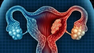 Các yếu tố nguy cơ gây ung thư buồng trứng