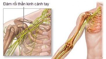 Gây tê đám rối thần kinh cánh tay phẫu thuật nội soi thoái hóa khớp cùng đòn