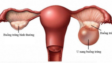 Gây mê nội khí quản phẫu thuật cắt u buồng trứng hoặc bóc u buồng trứng