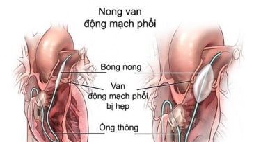 Chỉ định nong hẹp nhánh động mạch phổi