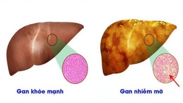 Nguyên nhân khiến người cao tuổi dễ mắc gan nhiễm mỡ