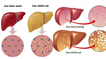 Gan nhiễm mỡ độ mấy là nặng? Điều trị như thế nào