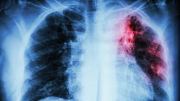 Chẩn đoán hình ảnh lao phổi