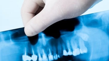 Chụp X quang răng được chỉ định trong trường hợp nào?