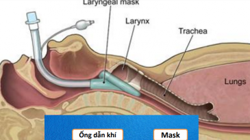 Gây mê mask thanh quản phẫu thuật nội soi xẻ sa lồi lỗ niệu quản