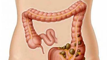 Viêm túi thừa đại tràng: Mổ hay không?