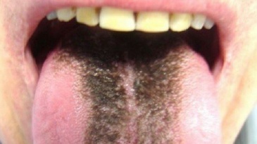 Lưỡi lông đen: Nguyên nhân, triệu chứng