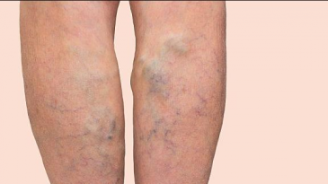 Huyết khối tĩnh mạch sâu