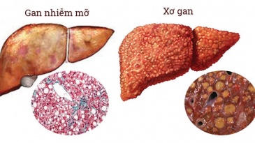 Bệnh gan nhiễm mỡ ở trẻ em và những điều cha mẹ cần biết