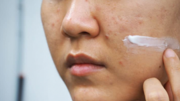 Mụn nội tiết là gì và cách điều trị