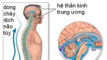 Gây mê nội khí quản đóng đường dò dịch não tủy