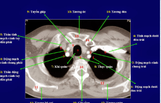 Quy trình chụp cắt lớp vi tính lồng ngực có tiêm thuốc đối quang i -ốt