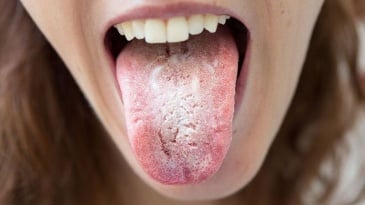 Nhiễm nấm Candida ở miệng, cổ họng và thực quản