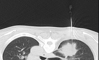 Sinh thiết phổi/màng phổi dưới cắt lớp vi tính