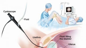 Lưu ý quan trọng với người bệnh được đặt Sonde JJ