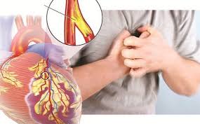 Bệnh mạch vành là gì, Biểu hiện, nguyên nhân và cách điều trị