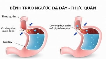 Tìm hiểu về bệnh trào ngược dạ dày thực quản