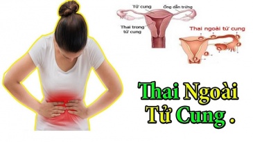 Thai ngoài tử cung mấy tuần thì vỡ và sản phụ cần làm gì?