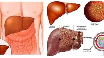 Biểu hiện xơ gan cổ trướng và cách điều trị hiệu quả