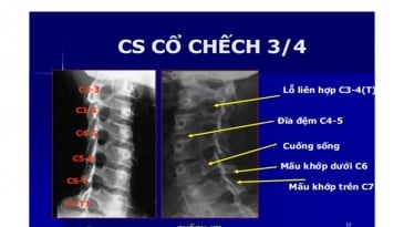 Chụp X quang cột sống cổ chếch 3⁄4 để chẩn đoán bênh cột sống