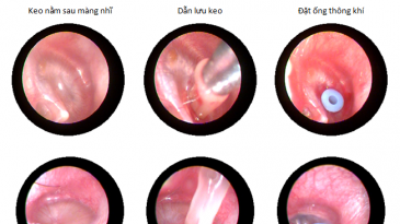 Kỹ thuật Rạch chích mủ màng nhĩ chữa viêm tai giữa