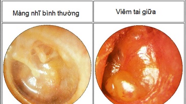 Viêm tai giữa có thể gây thủng màng nhĩ không?