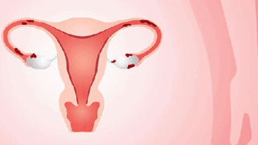 Lạc nội mạc tử cung và thụ tinh trong ống nghiệm IVF điều trị vô sinh