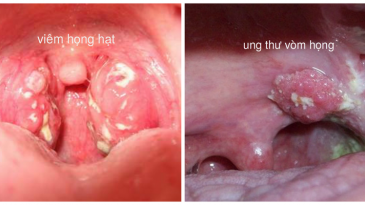 Phân biệt viêm họng thông thường và ung thư vòm họng