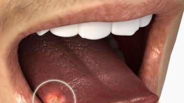 Những đối tượng nên tầm soát sàng lọc ung thư lưỡi?