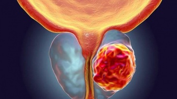 Thuốc trị ung thư vú và buồng trứng trong ung thư tuyến tiền liệt giai đoạn muộn
