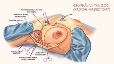 Tìm hiểu về phẫu thuật cắt bỏ vú điều trị nang tuyến vú