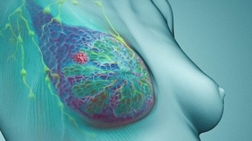 Ung thư vú: Cập nhật mới liên quan đến điều trị vô sinh