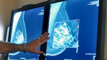 Chụp X quang tuyến vú biện pháp tầm soát ung thư vú hiệu quả
