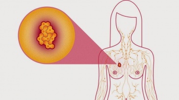 Các phương pháp thường dùng trong phẫu thuật điều trị ung thư vú