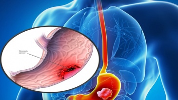 Ung thư dạ dày có những yếu tố nguy cơ nào?