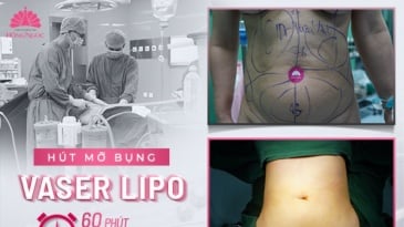 Hút mỡ bụng Thẩm mỹ Bệnh viện hồng ngọc bằng công nghệ Vaser Lipo - 60 phút trút sạch mỡ