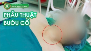 Bướu Cổ: Hiểu Rõ Để Sống Khỏe Và Tự Tin